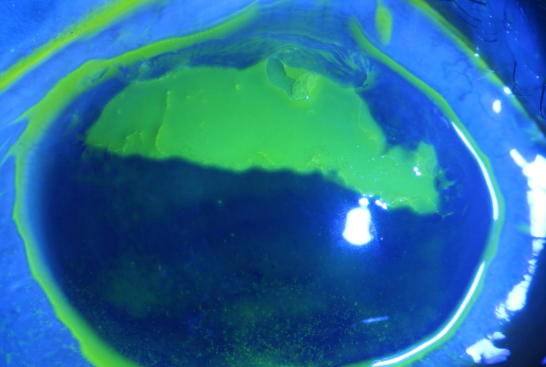 正规长沙配资平台 误将“一滴甲”当眼药水 女子右眼被烧伤险失明